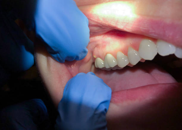 Best Emergency Dental Care for Abscessed Tooth in Baraga, MI
